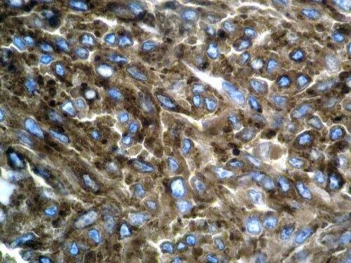 IHC of CD63 on an FFPE Melanoma Tissue